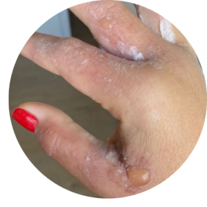 5 ideias de títulos:
1. Fitofotodermatite: O que é e como prevenir a queimadura por limão.
2. Sintomas e tratamentos eficazes para a queimadura de limão.
3. Cuidados essenciais após o contato da pele com limão e sol.
4. Mitos e verdades sobre as manchas de limão na pele.
5. Quando procurar um dermatologista para tratar a fitofotodermatite.