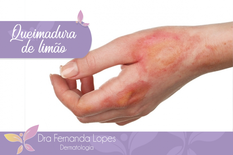 queimadura com limão fotos