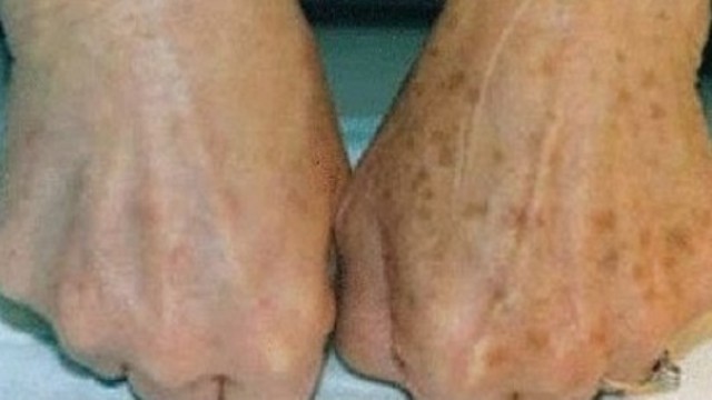 5 ideias de títulos:
1. Fitofotodermatite: O que é e como prevenir a queimadura por limão.
2. Sintomas e tratamentos eficazes para a queimadura de limão.
3. Cuidados essenciais após o contato da pele com limão e sol.
4. Mitos e verdades sobre as manchas de limão na pele.
5. Quando procurar um dermatologista para tratar a fitofotodermatite.