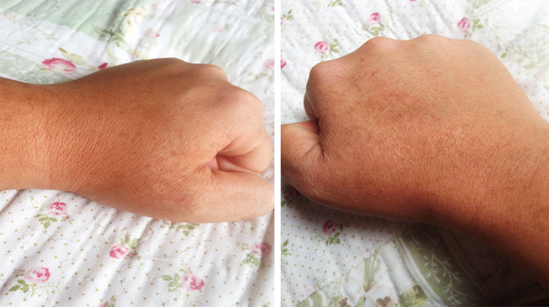 queimadura com limão fotos