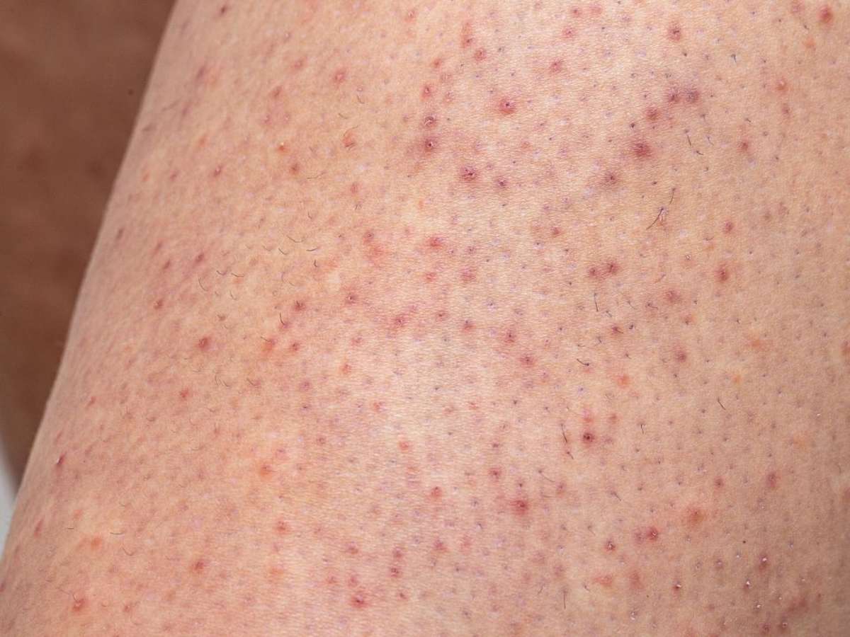 Melhores Cremes e Hidratantes para Pele de Galinha