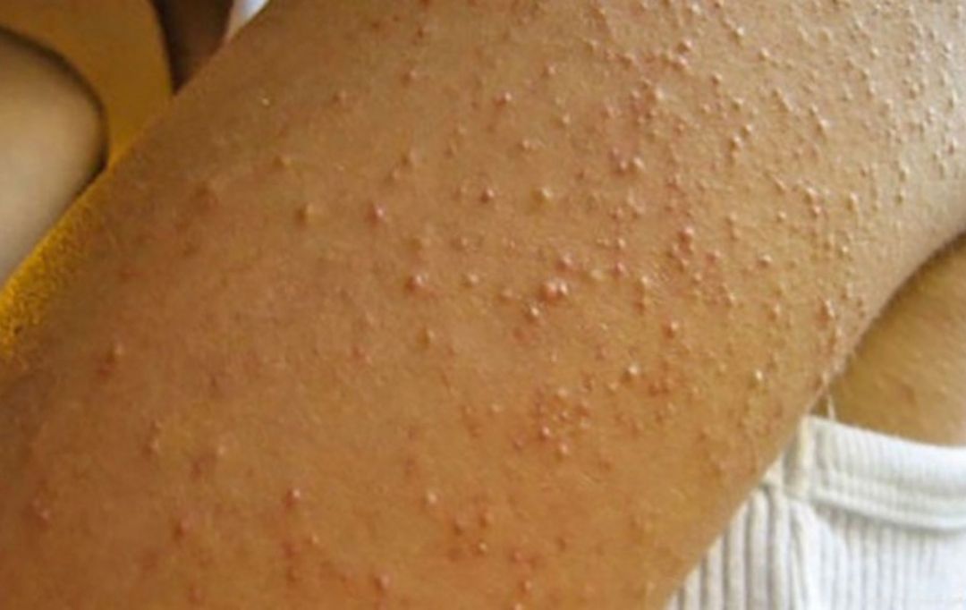 Melhores Cremes e Hidratantes para Pele de Galinha