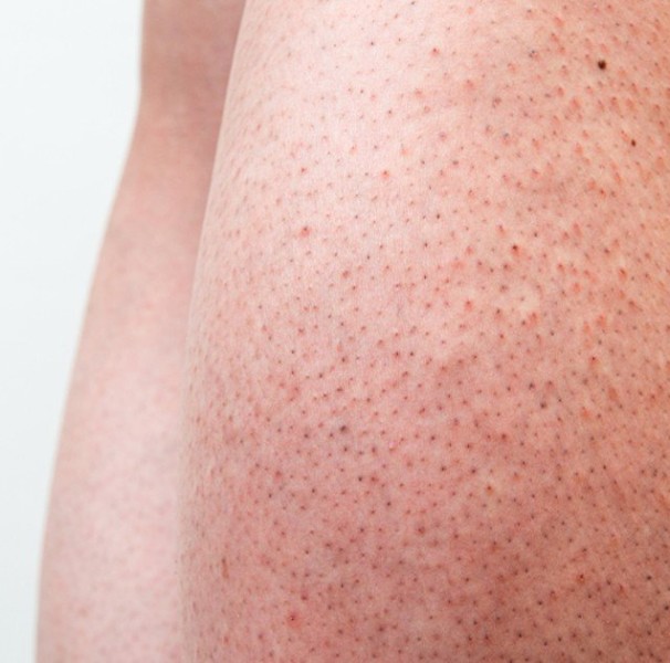 Ácidos Essenciais no Tratamento da Queratose Pilar