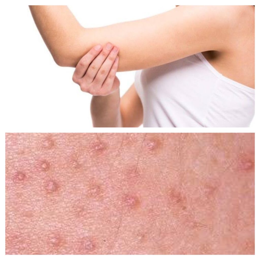 Dicas de Banho para Aliviar a Queratose Pilar