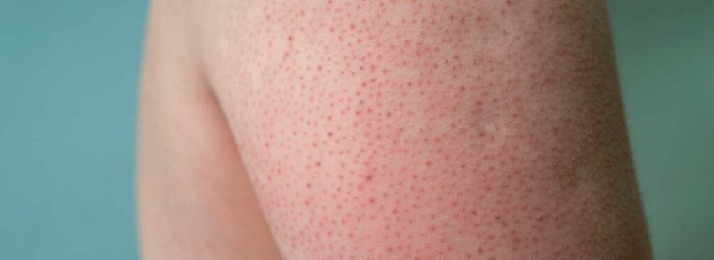 Queratose Pilar no Rosto: Como Tratar as Bochechas