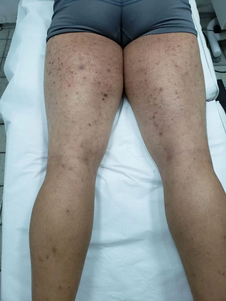 O que é Queratose Pilar e Como Identificar?