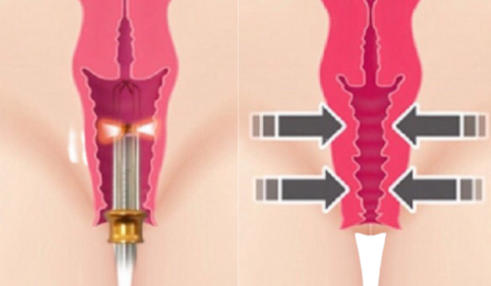 rejuvenescimento intimo