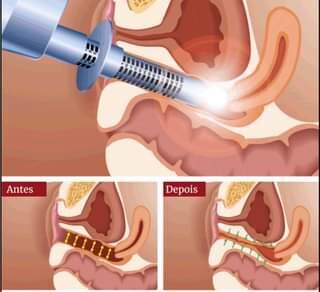 Rejuvenescimento Íntimo Feminino: Guia Completo de Técnicas e Benefícios