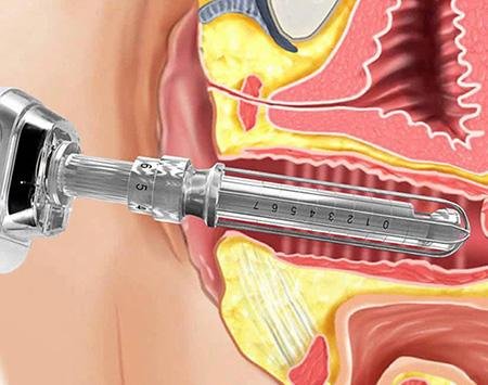 Scrotox e Bioestimuladores: Inovações na Estética Íntima Masculina e Feminina