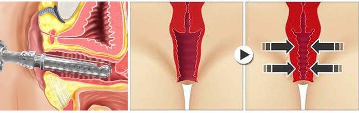 rejuvenescimento intimo