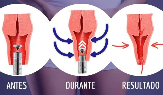 Laser Íntimo: Tudo o que Você Precisa Saber sobre o Tratamento Vaginal