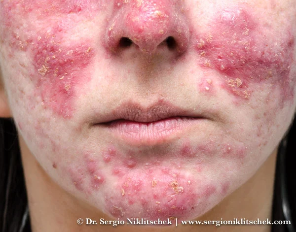 cuidados com a pele sensível com rosácea