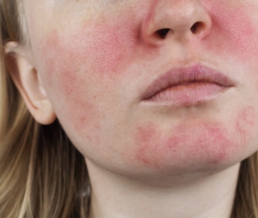 remédios caseiros para rosácea