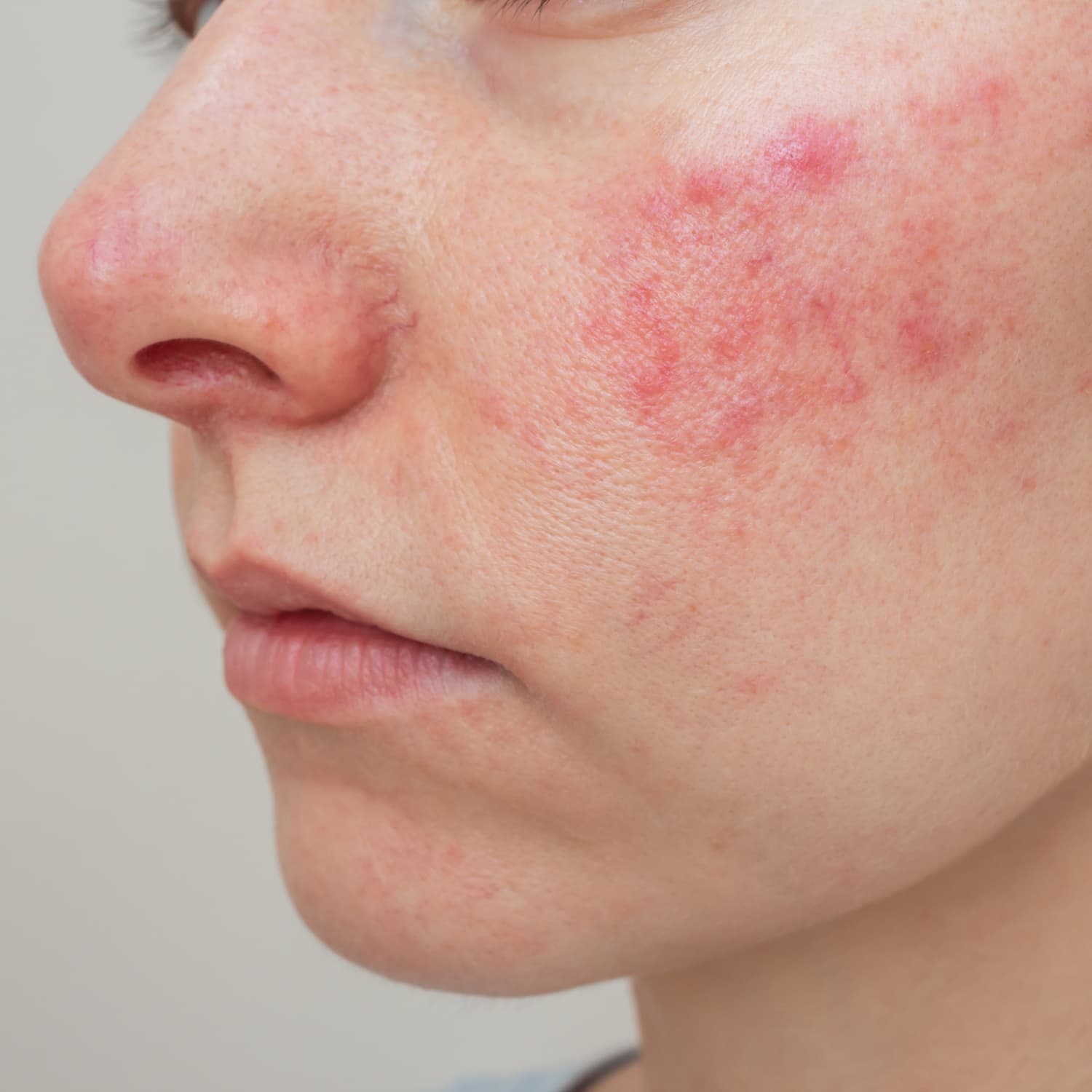 diferença entre rosácea e acne