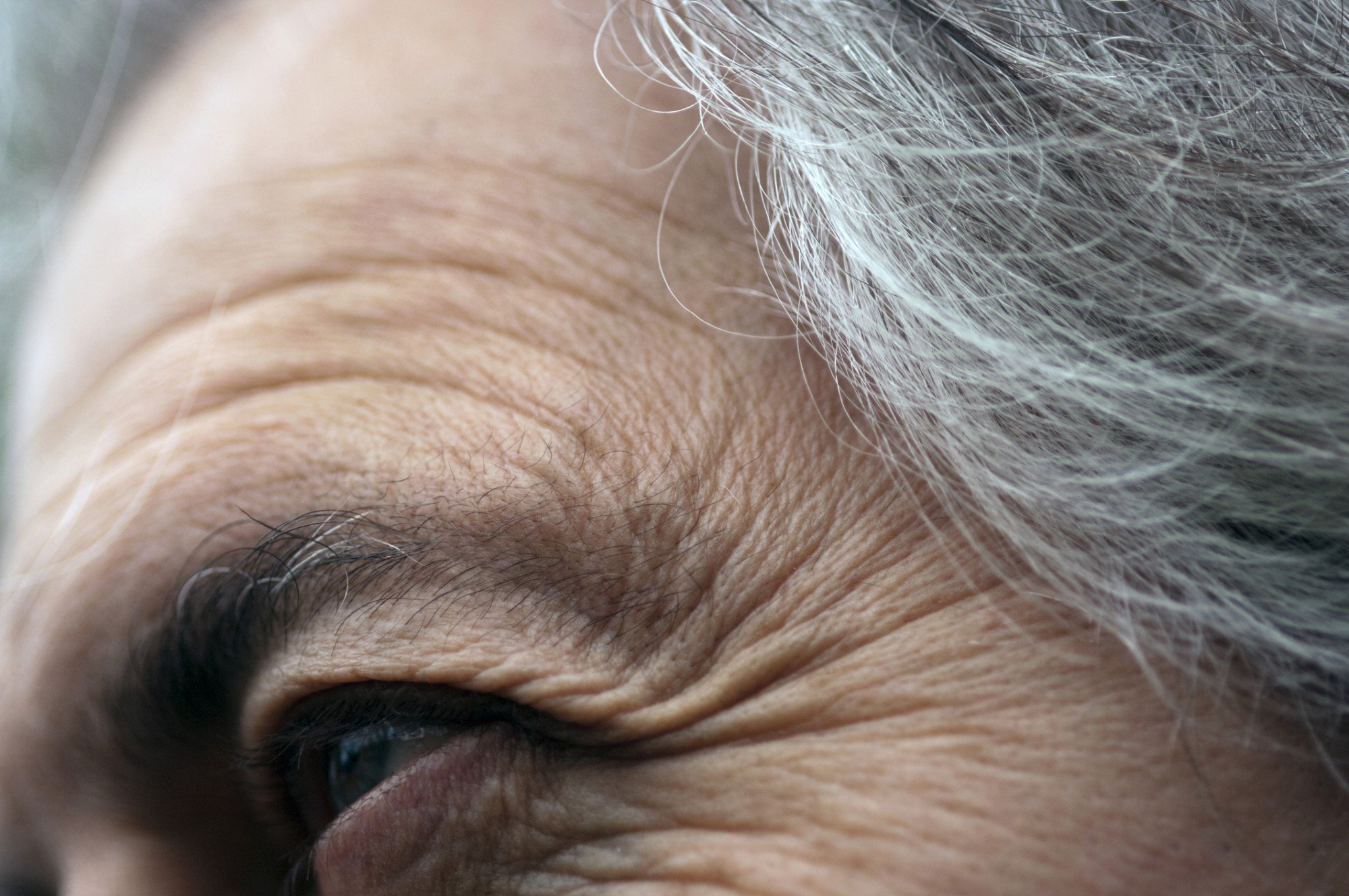 Botox vs. Preenchedores: Qual o Melhor Tratamento para Suas Rugas?