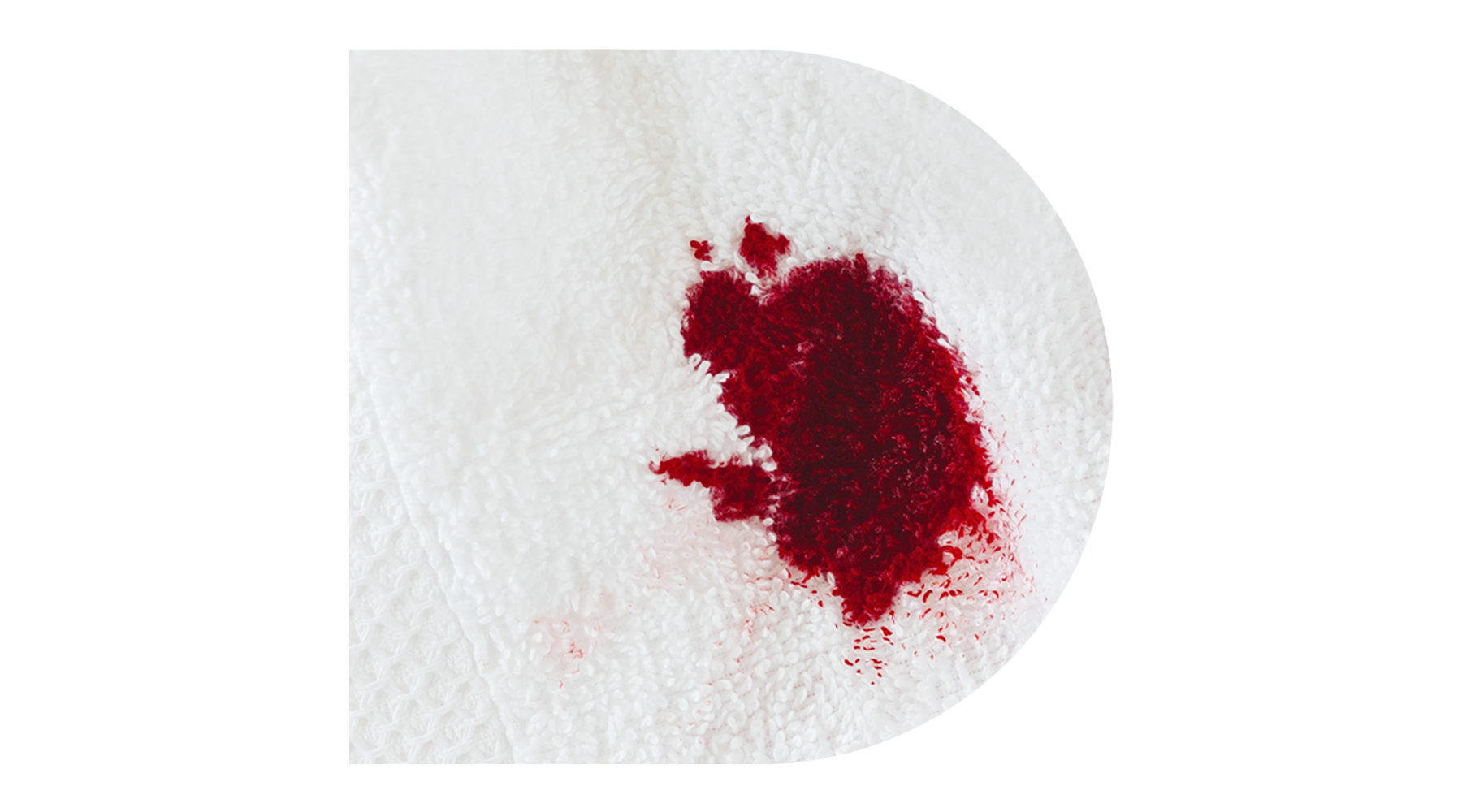 Pólipos Cervicais: Entenda a Relação com o Sangramento Após o Sexo