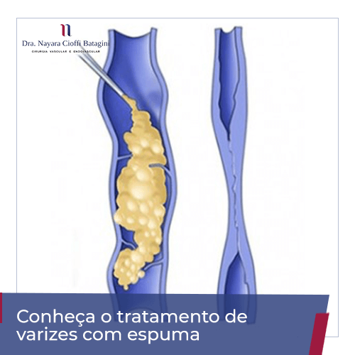 tratamento de varizes com espuma