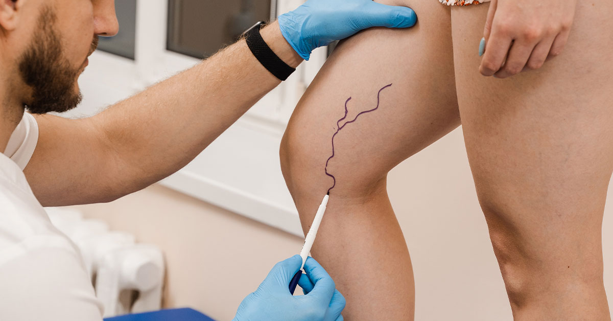 tratamento de varizes com espuma