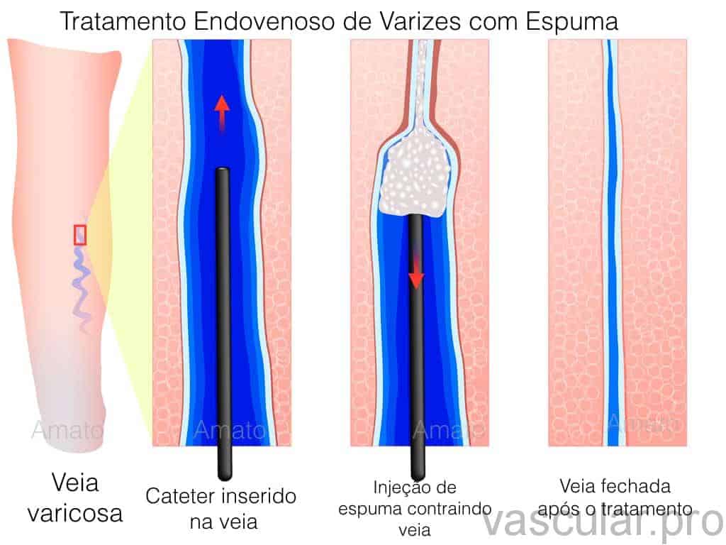 tratamento de varizes com espuma
