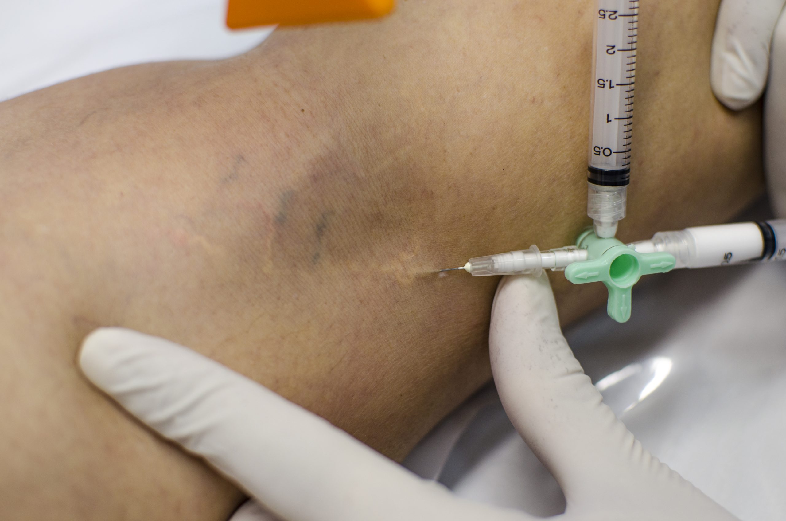 tratamento de varizes com espuma