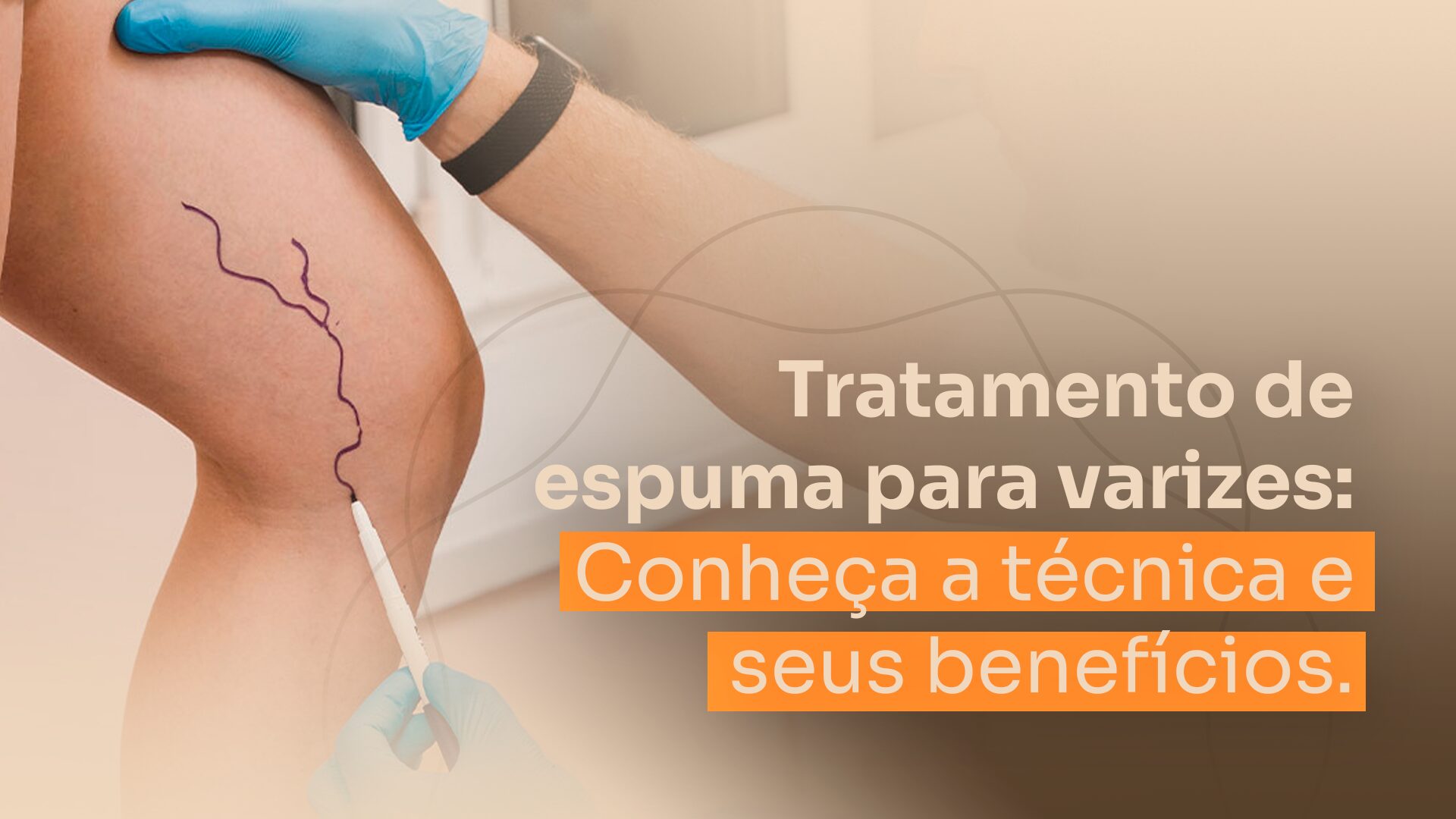 tratamento de varizes com espuma
