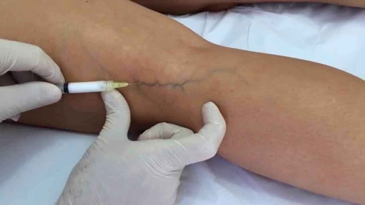 tratamento de varizes com espuma