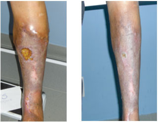 tratamento de varizes com espuma