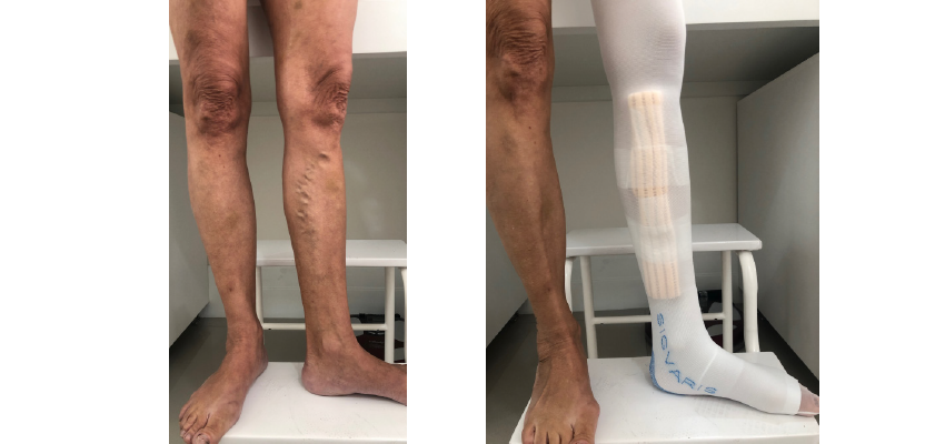 tratamento de varizes com espuma