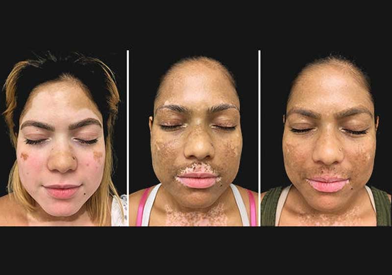 tratamento de vitiligo