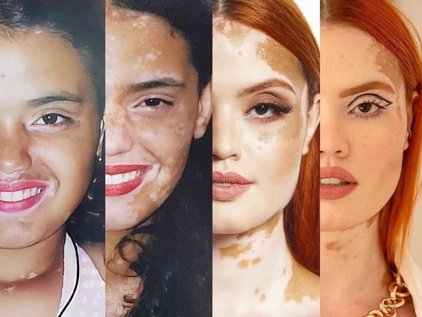 1. Vitiligo: Entenda as Causas e os Tratamentos Mais Eficazes
2. Fototerapia para Vitiligo: Como Funciona e Quais os Benefícios?
3. Medicamentos Tópicos no Tratamento do Vitiligo: Guia Completo
4. Cirurgia para Vitiligo: Quando é Indicada e Quais os Procedimentos?
5. Cuidados Essenciais e Estilo de Vida para Pessoas com Vitiligo