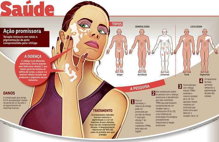 1. Vitiligo: Entenda as Causas e os Tratamentos Mais Eficazes
2. Fototerapia para Vitiligo: Como Funciona e Quais os Benefícios?
3. Medicamentos Tópicos no Tratamento do Vitiligo: Guia Completo
4. Cirurgia para Vitiligo: Quando é Indicada e Quais os Procedimentos?
5. Cuidados Essenciais e Estilo de Vida para Pessoas com Vitiligo