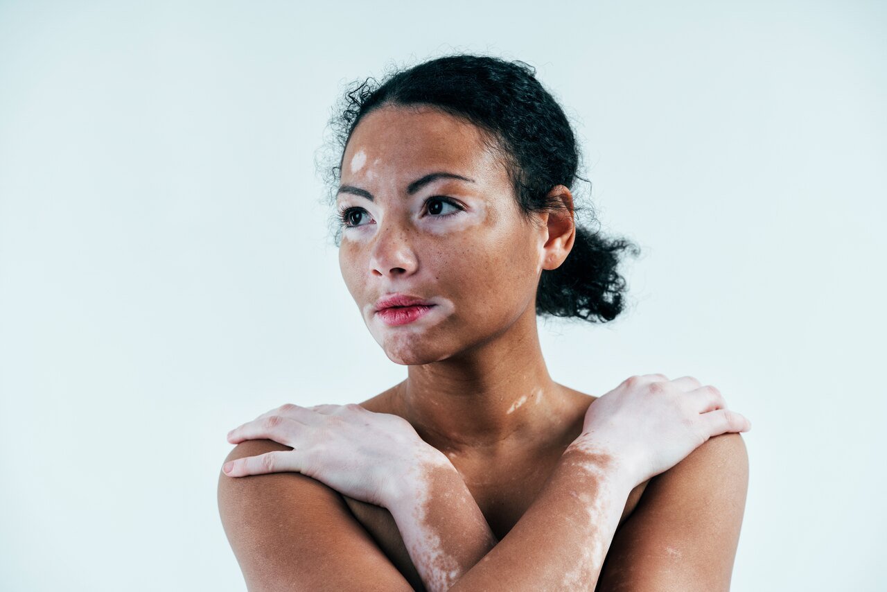 tratamento de vitiligo