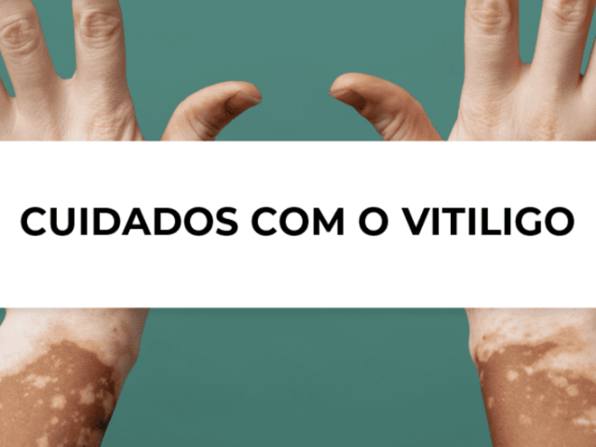 1. Vitiligo: Entenda as Causas e os Tratamentos Mais Eficazes
2. Fototerapia para Vitiligo: Como Funciona e Quais os Benefícios?
3. Medicamentos Tópicos no Tratamento do Vitiligo: Guia Completo
4. Cirurgia para Vitiligo: Quando é Indicada e Quais os Procedimentos?
5. Cuidados Essenciais e Estilo de Vida para Pessoas com Vitiligo