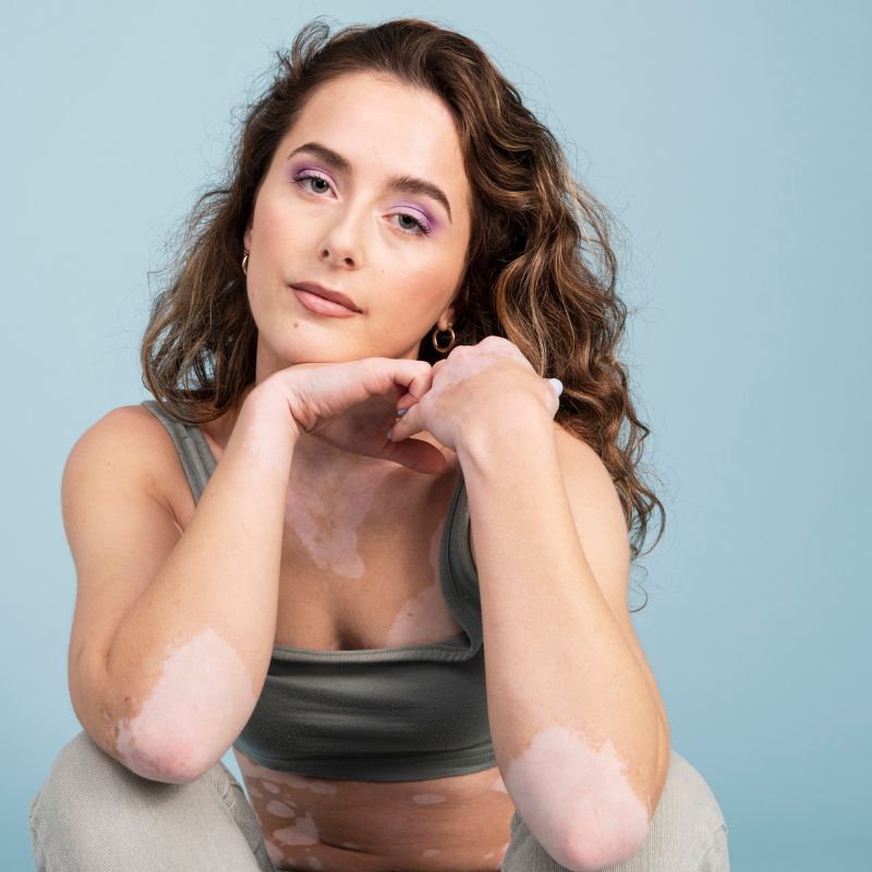 tratamento de vitiligo