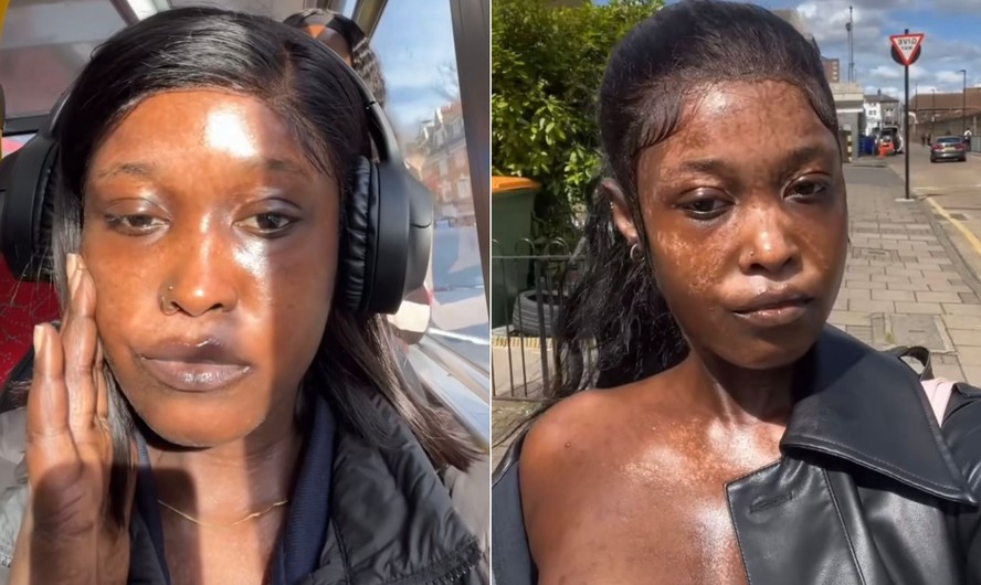 1. Vitiligo: Entenda as Causas e os Tratamentos Mais Eficazes
2. Fototerapia para Vitiligo: Como Funciona e Quais os Benefícios?
3. Medicamentos Tópicos no Tratamento do Vitiligo: Guia Completo
4. Cirurgia para Vitiligo: Quando é Indicada e Quais os Procedimentos?
5. Cuidados Essenciais e Estilo de Vida para Pessoas com Vitiligo