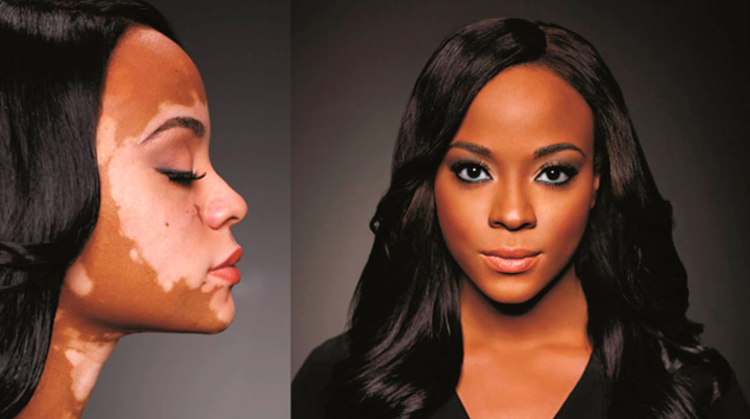 tratamento de vitiligo