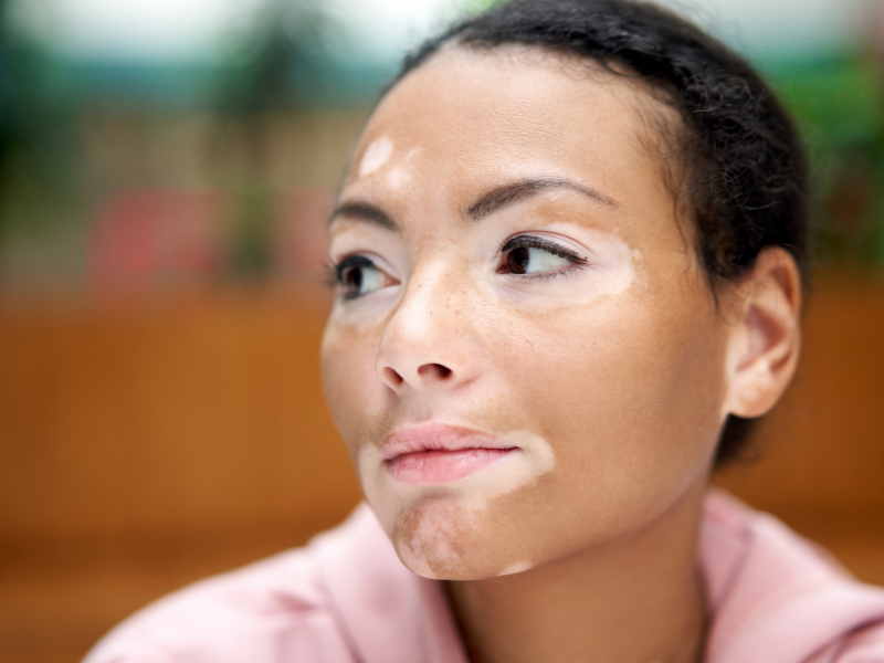 1. Vitiligo: Entenda as Causas e os Tratamentos Mais Eficazes
2. Fototerapia para Vitiligo: Como Funciona e Quais os Benefícios?
3. Medicamentos Tópicos no Tratamento do Vitiligo: Guia Completo
4. Cirurgia para Vitiligo: Quando é Indicada e Quais os Procedimentos?
5. Cuidados Essenciais e Estilo de Vida para Pessoas com Vitiligo