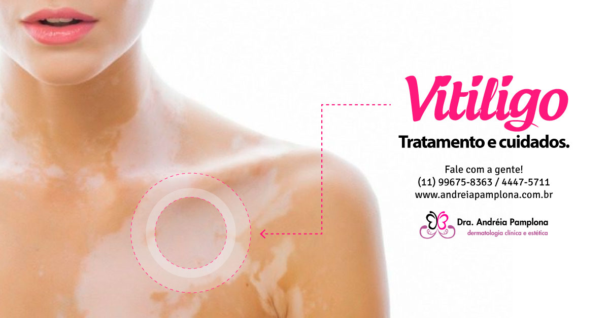 1. Vitiligo: Entenda as Causas e os Tratamentos Mais Eficazes
2. Fototerapia para Vitiligo: Como Funciona e Quais os Benefícios?
3. Medicamentos Tópicos no Tratamento do Vitiligo: Guia Completo
4. Cirurgia para Vitiligo: Quando é Indicada e Quais os Procedimentos?
5. Cuidados Essenciais e Estilo de Vida para Pessoas com Vitiligo