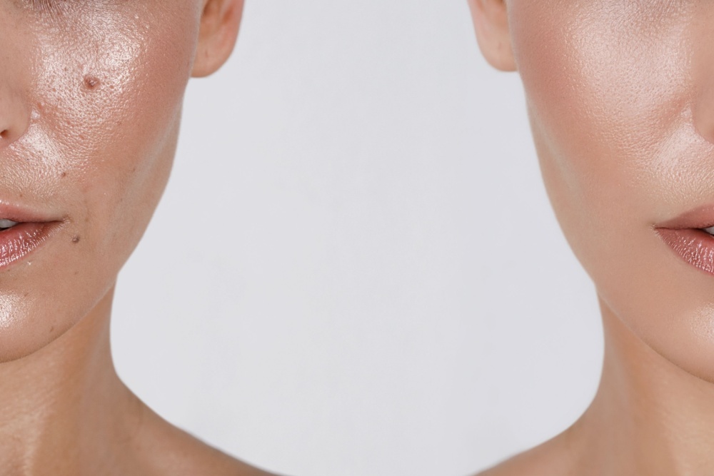 Diferenças entre sérum e hidratante no tratamento da acne