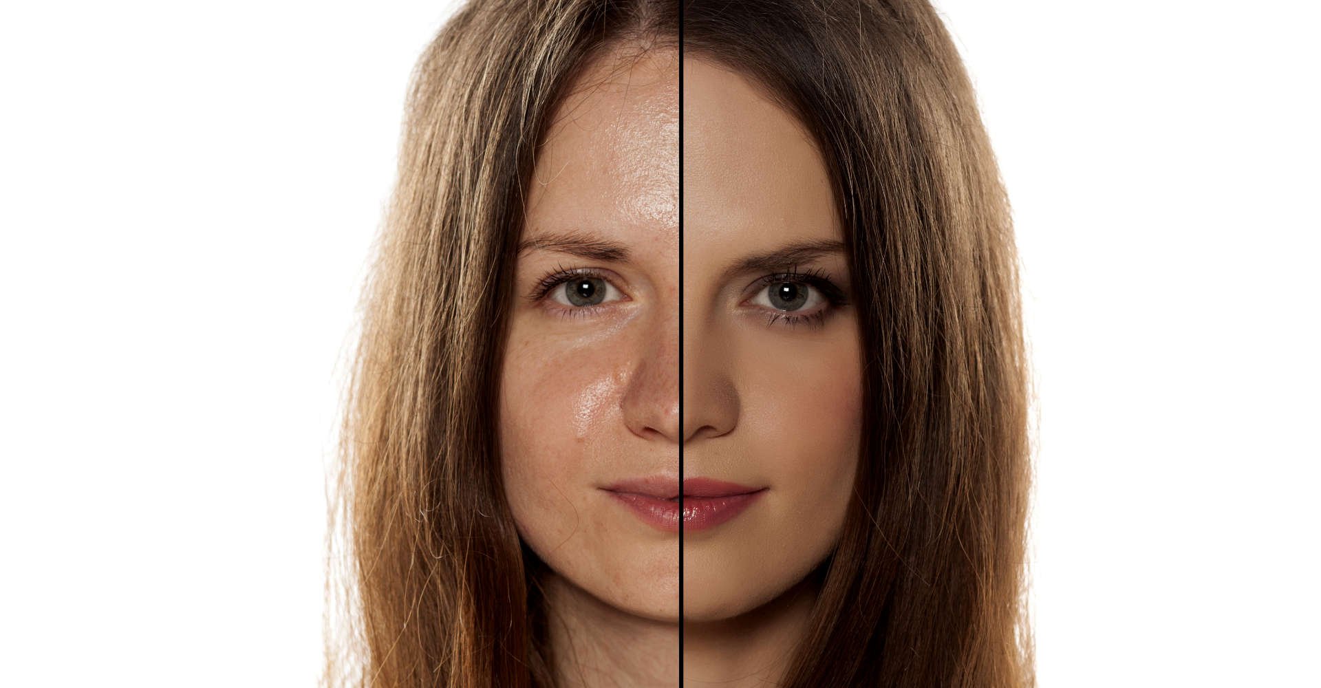 Como escolher o melhor sérum antiacne para sua pele