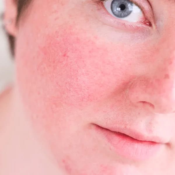 vermelhidão no rosto