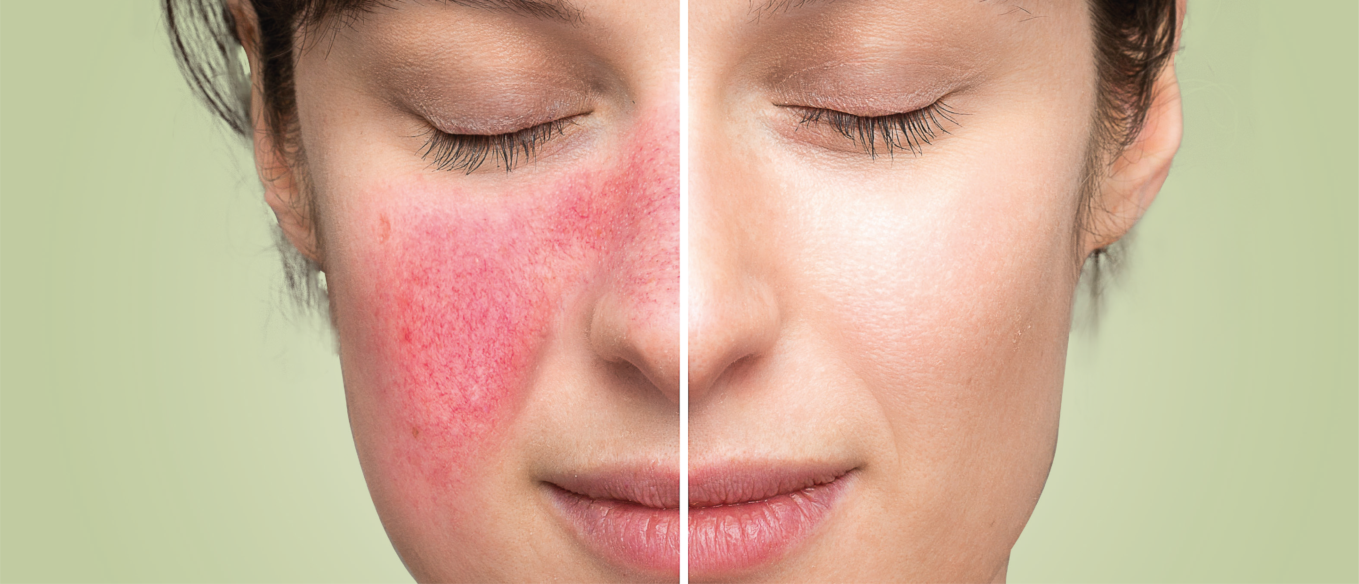 Guia completo sobre Rosácea: Sintomas e Tratamentos