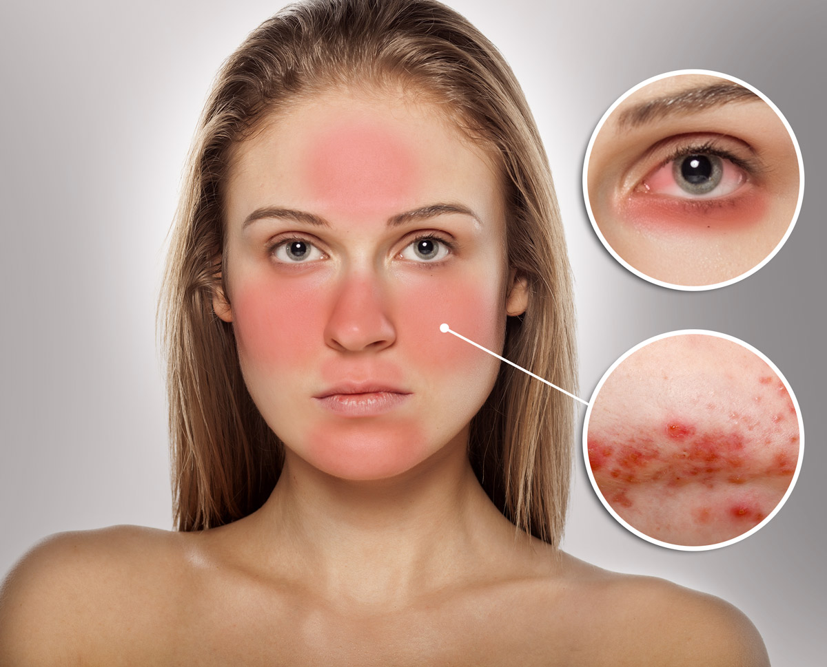Acne Inflamatória: Dicas para Reduzir a Vermelhidão