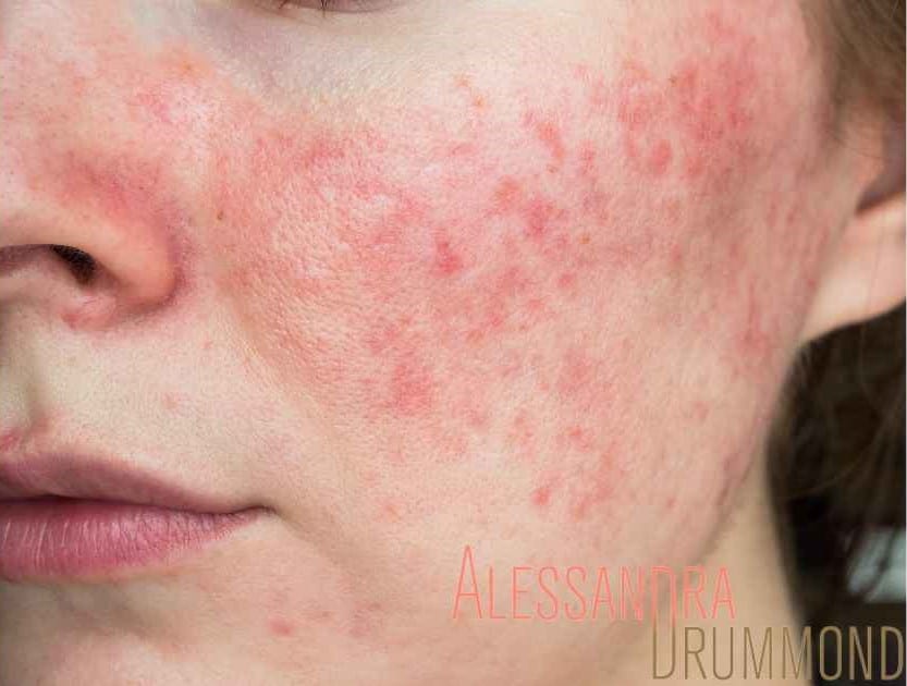 Fatores Ambientais que Afetam a Pele do Rosto