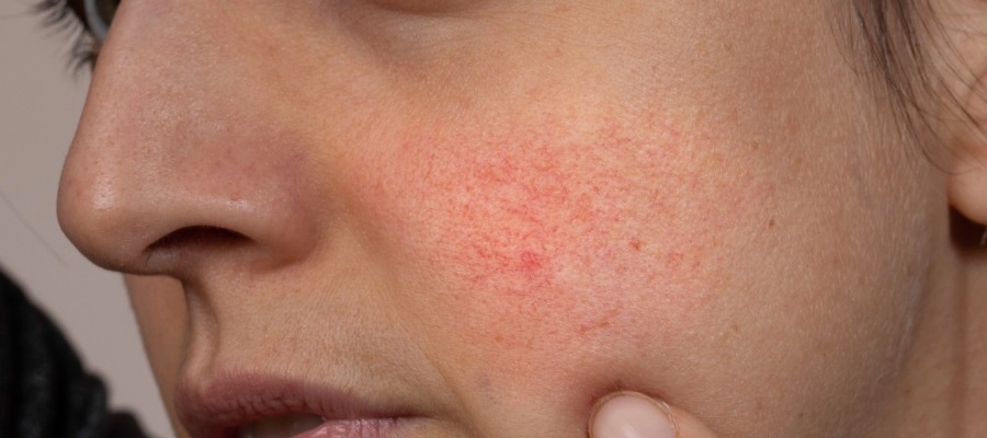 vermelhidão no rosto