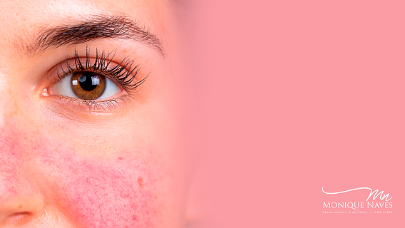 Dermatite de Contato: Como Identificar e Tratar