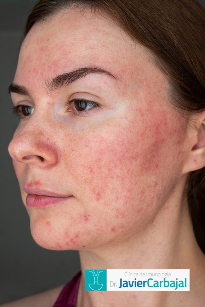 Acne Inflamatória: Dicas para Reduzir a Vermelhidão